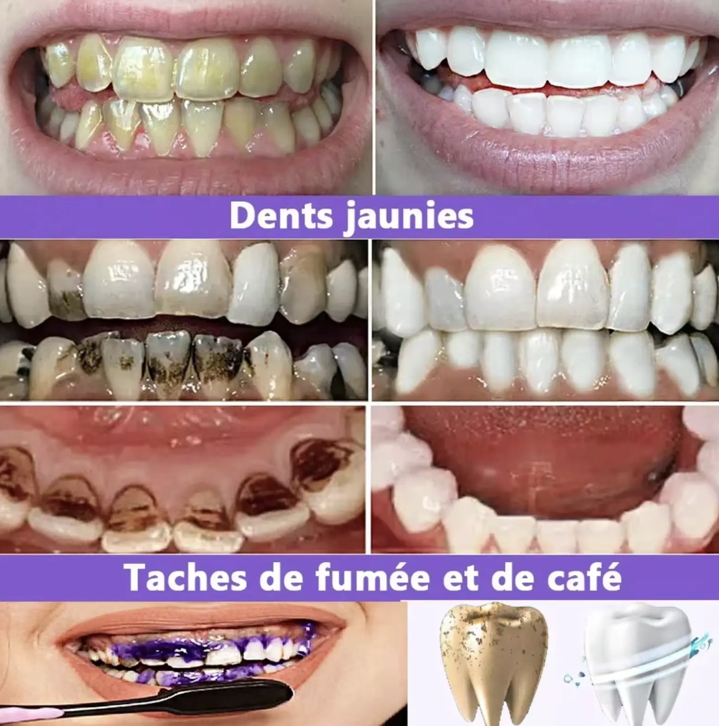 Smilekit V34 – Bielenie zubov sérum