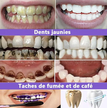 Smilekit V34 – Bielenie zubov sérum